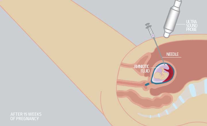 Amniocentesis